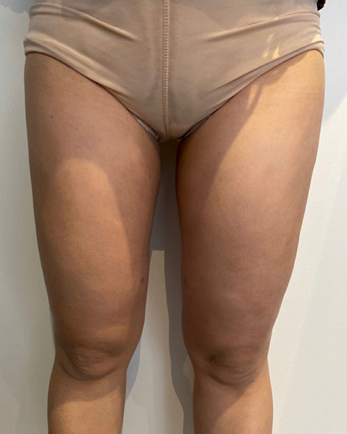Body Lift Before and after photos by Toronto plastic surgeon Dr. Golger