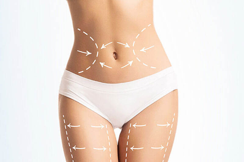 Liposuction