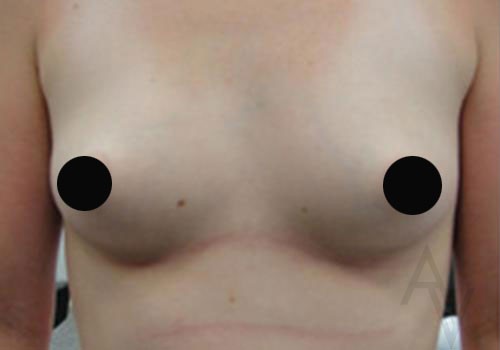 Breast Augmentation before and after images in Toronto