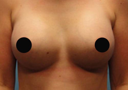 Breast Augmentation before and after images in Toronto