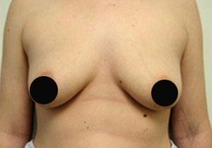 Breast Augmentation