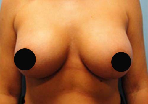 Breast Augmentation