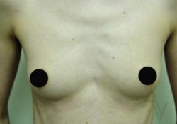 Breast Augmentation