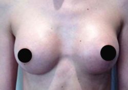 Breast Augmentation