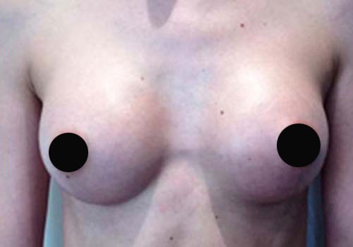 Breast Augmentation Case 281 After Photo Breast Augmentation