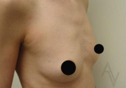 Breast Augmentation