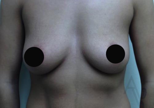 Breast Augmentation