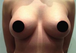 Breast Augmentation