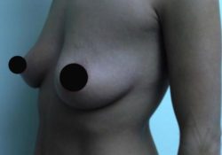 Breast Augmentation