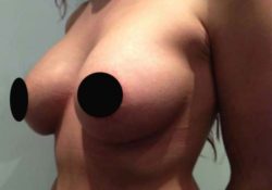 Breast Augmentation