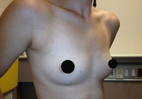 Breast Augmentation Case 283 Before Photo Breast Augmentation