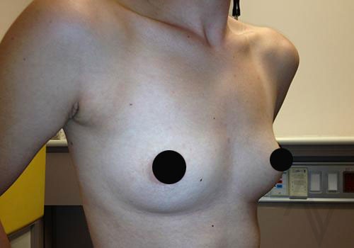 Breast Augmentation