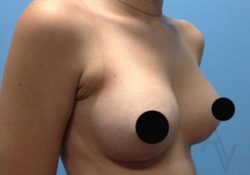 Breast Augmentation