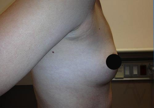 Breast Augmentation