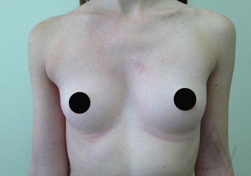 Breast Augmentation Case 284 Before Photo Breast Augmentation