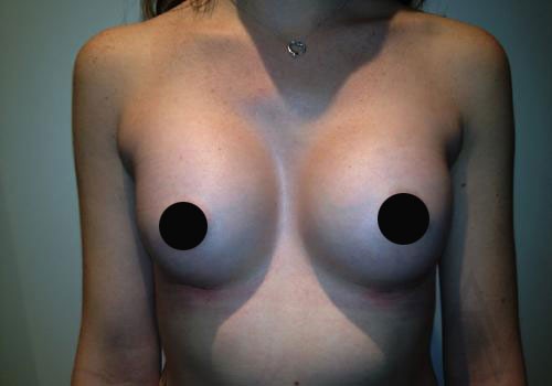 Breast Augmentation Case 284 After Photo Breast Augmentation