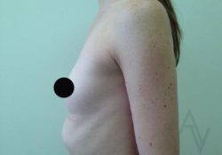 Breast Augmentation