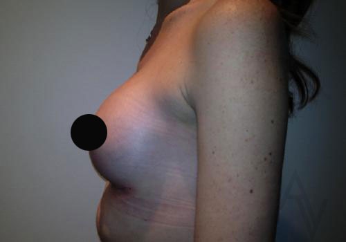 Breast Augmentation