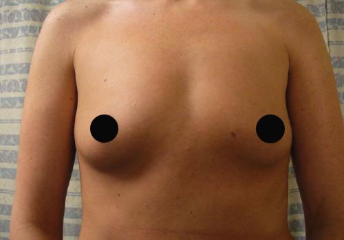 Breast Augmentation Case 285 Before Photo Breast Augmentation