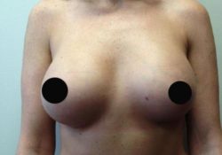 Breast Augmentation