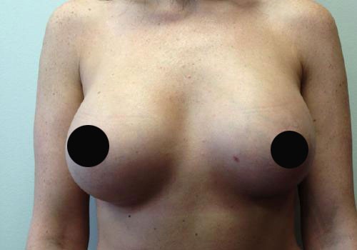 Breast Augmentation Case 285 After Photo Breast Augmentation