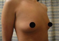 Breast Augmentation