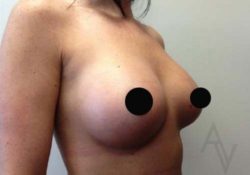 Breast Augmentation