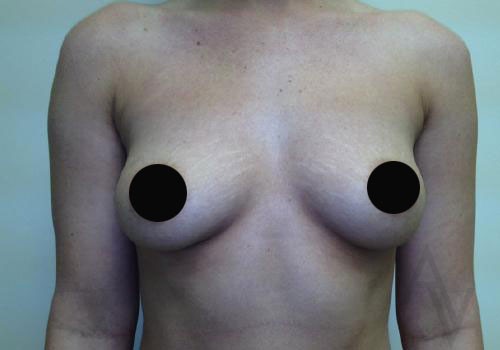 Breast Augmentation Case 286 Before Photo Breast Augmentation