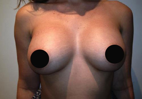 Breast Augmentation Case 286 After Photo Breast Augmentation