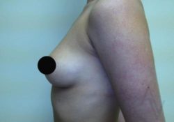 Breast Augmentation