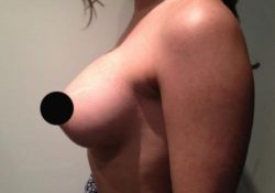 Breast Augmentation