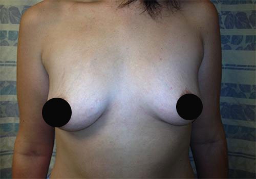 Breast Augmentation Case 287 Before Photo Breast Augmentation