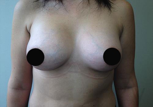 Breast Augmentation Case 287 After Photo Breast Augmentation