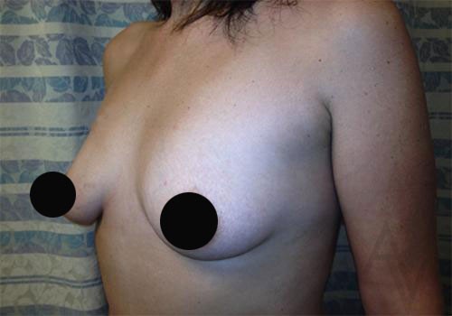 Breast Augmentation