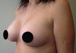 Breast Augmentation