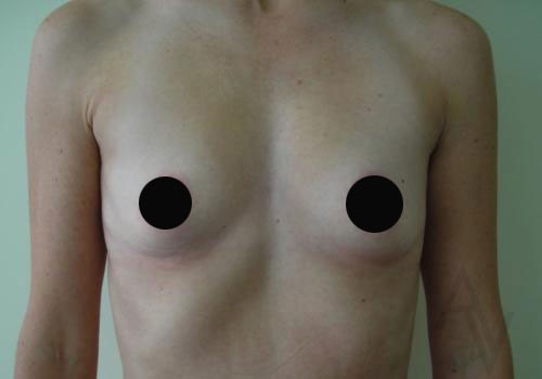 Breast Augmentation Case 288 Before Photo Breast Augmentation