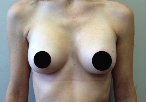 Breast Augmentation Case 288 After Photo Breast Augmentation