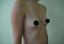 Breast Augmentation