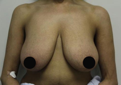 Breast Lift Case 330 Before Photo Breast Lift