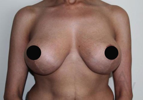 Breast Lift Before and after photos by Toronto Plastic Surgeon Dr. Golger