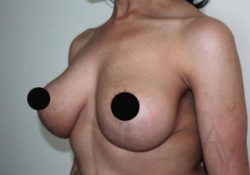 Breast Lift