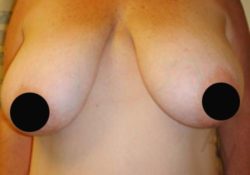 Breast Reduction