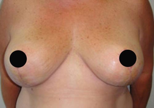 Toronto Breast Reduction Before and after photos