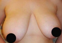 Breast Reduction