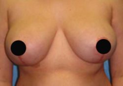 Breast Reduction