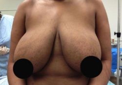 Breast Reduction