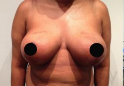 Breast Reduction