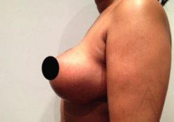 Breast Reduction