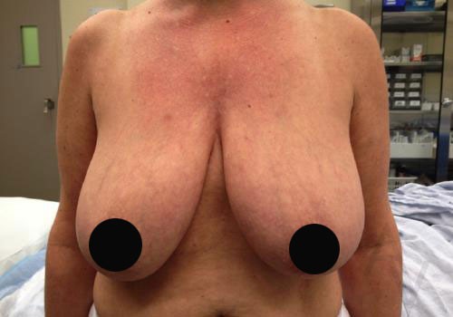 Breast Reduction