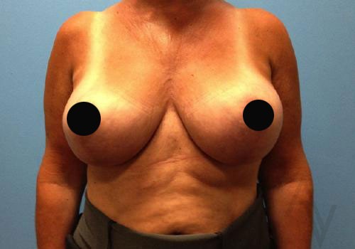 Breast Reduction